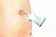 An umbilical port is created for the laparoscope.
