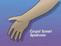 Your doctor has recommended that you undergo hand surgery to treat carpal tunnel syndrome. But what exactly is carpal tunnel syndrome?