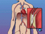 Once the tube is in place, a small balloon is briefly inflated in order to widen the narrowed artery.