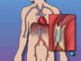 A short length of mesh tubing called a stent is then inserted into the newly widened artery.