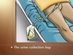 <UL><LI>The urine collection bag which is attached to the bed frame below the level of the man's bladder</LI></UL>