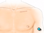 Then the surgeon will make a small skin incision in the upper chest, just below the collarbone.