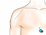 Then, when you are asleep, the surgical team will make an incision over the shoulder.