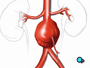 ... revealing the aorta and the aneurysm. Now your doctor can begin to remove the clot.
